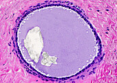 Oxalate calcification in breast biopsy, light micrograph