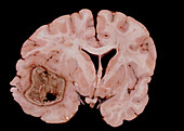 Human brain abscess