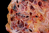Human polycystic kidney