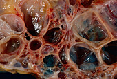 Human polycystic kidney