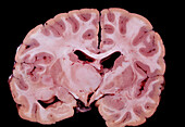 Human brain astrocytoma