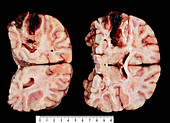 Haemorrhagic stroke