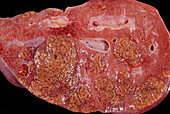 Hepatocarcinoma