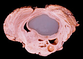 Pilocytic astrocytoma
