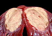 Renal cell carcinoma