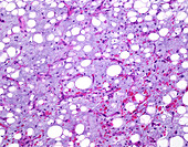 Liposarcoma, light micrograph