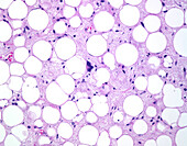 Well-differentiated liposarcoma, light micrograph