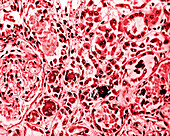 Kidney tissue of a patient with cholera, light micrograph