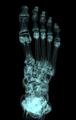 Foot, CT scan