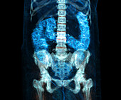 Large intestine, CT scan