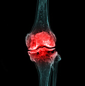 Knee pain, conceptual image