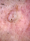 Wart, dermoscopy