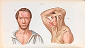 Plastic surgery of the nose, illustration