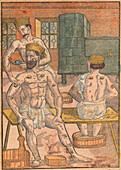 Cupping therapy, 16th century illustration