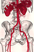 Iliac arteries, CT scan