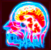 Healthy head and brain, MRI scan