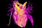 Healthy heart, CT scan