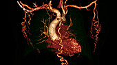 Collateral circulation in aortic coarctation, CT scan