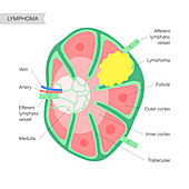 Lymphoma, conceptual illustration