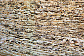 Damaged myelinated fibres, light micrograph