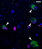 Covid-19 virus particles, immunofluorescent light micrograph