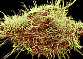 Cervial cancer cell, SEM.