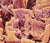 Tumour connective tissue, SEM