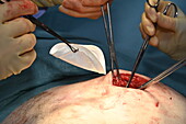 Incisional hernia repair operation