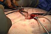 Hernia mesh being placed in abdominal wall