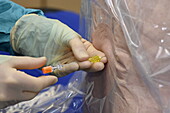 Insertion of epidural catheter