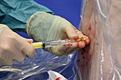 Epidural anaesthetic injection