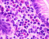 Eosinophils in inflamed appendix, light micrograph