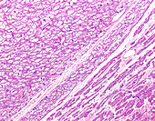 Cardiac rhabdomyoma, light micrograph