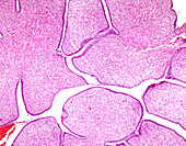 Adenosarcoma of uterus, light micrograph