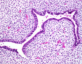 Adenosarcoma of uterus, light micrograph