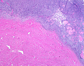 Endometrial stromal nodule, light micrograph