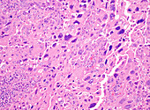 Endometrioid carcinoma of the uterus, light micrograph