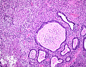 Tuberculous endometritis, light micrograph