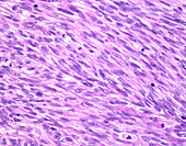 Uterine leiomyosarcoma, light micrograph