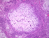 Carcinosarcoma, light micrograph