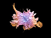 Lung cancer cell, SEM