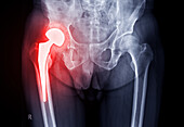 Hip replacement, X-ray