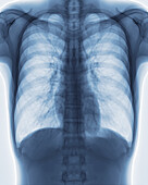 Healthy chest, X-ray