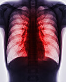 Lung disease, X-ray