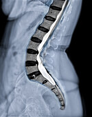 Compressed spinal cord, X-ray