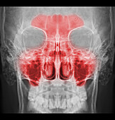 Sinus pain, conceptual X-ray