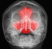 Sinus pain, conceptual X-ray