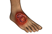 Buruli ulcer on a foot, illustration