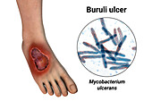 Buruli ulcer and Mycobacterium ulcerans, illustration