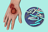 Buruli ulcer and Mycobacterium ulcerans, illustration